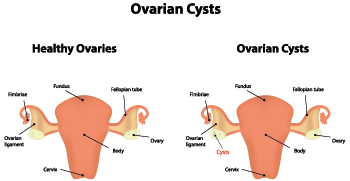 cyst ovarian surgery removal oophorectomy collect friend family after